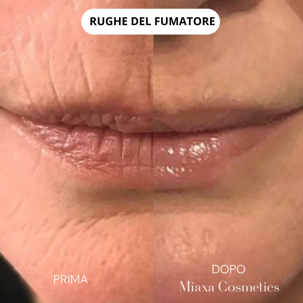 Kit Micro-Infusione Miaxa™ Soluzione Anti-Età