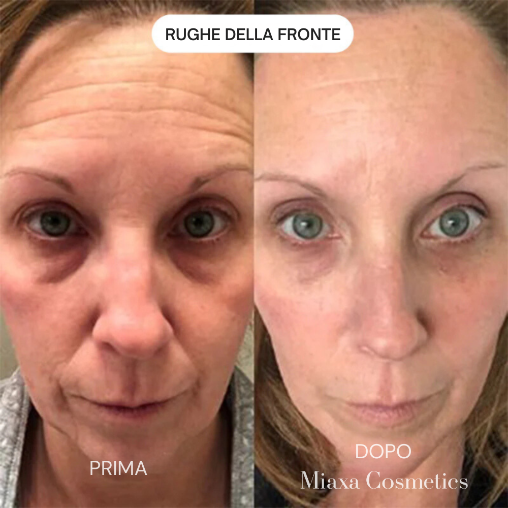Kit Micro-Infusione Miaxa™ Soluzione Anti-Età