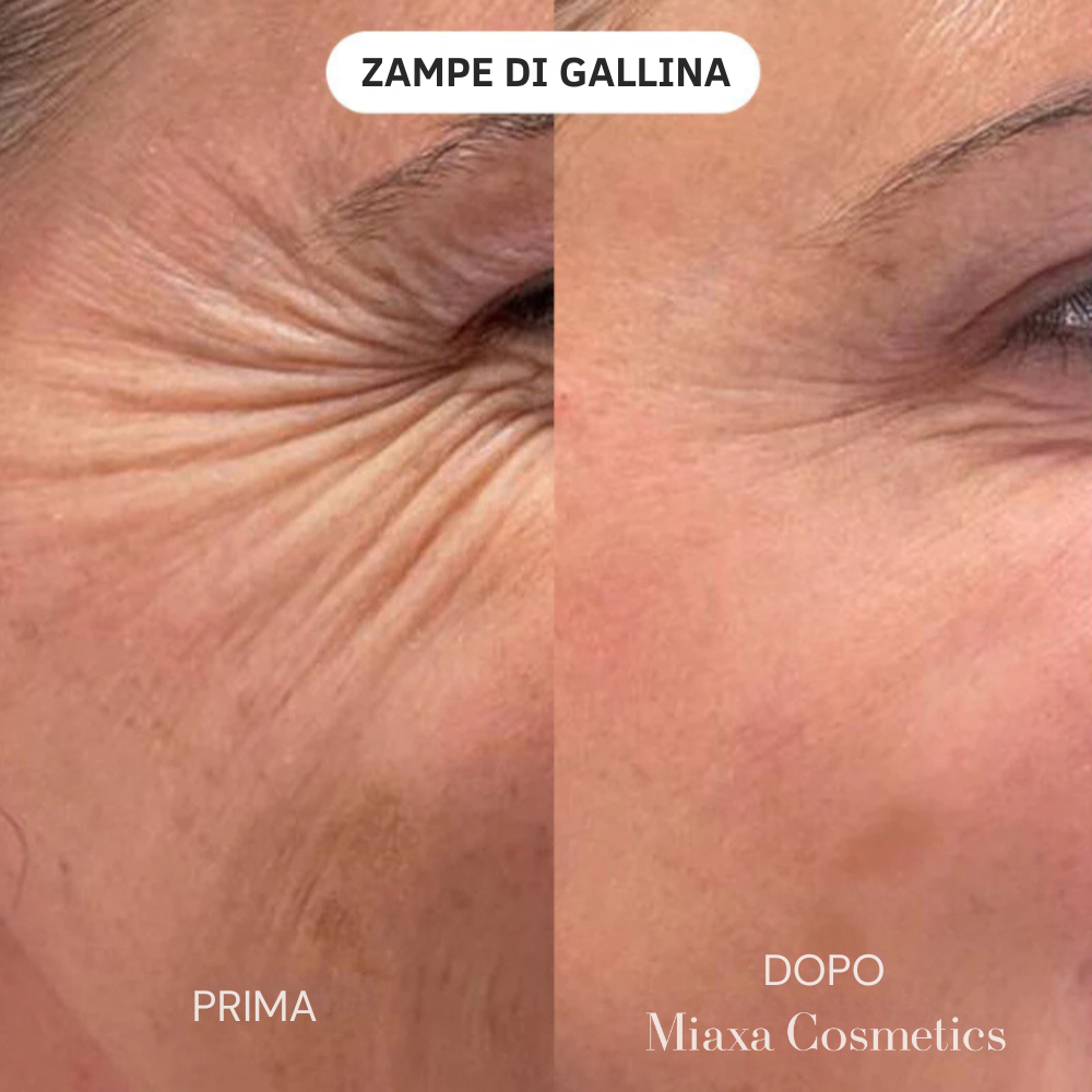 Kit Micro-Infusione Miaxa™ Soluzione Anti-Età
