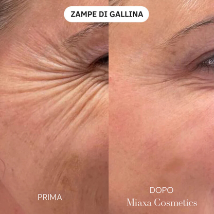 Kit Micro-Infusione Miaxa™ Soluzione Anti-Età